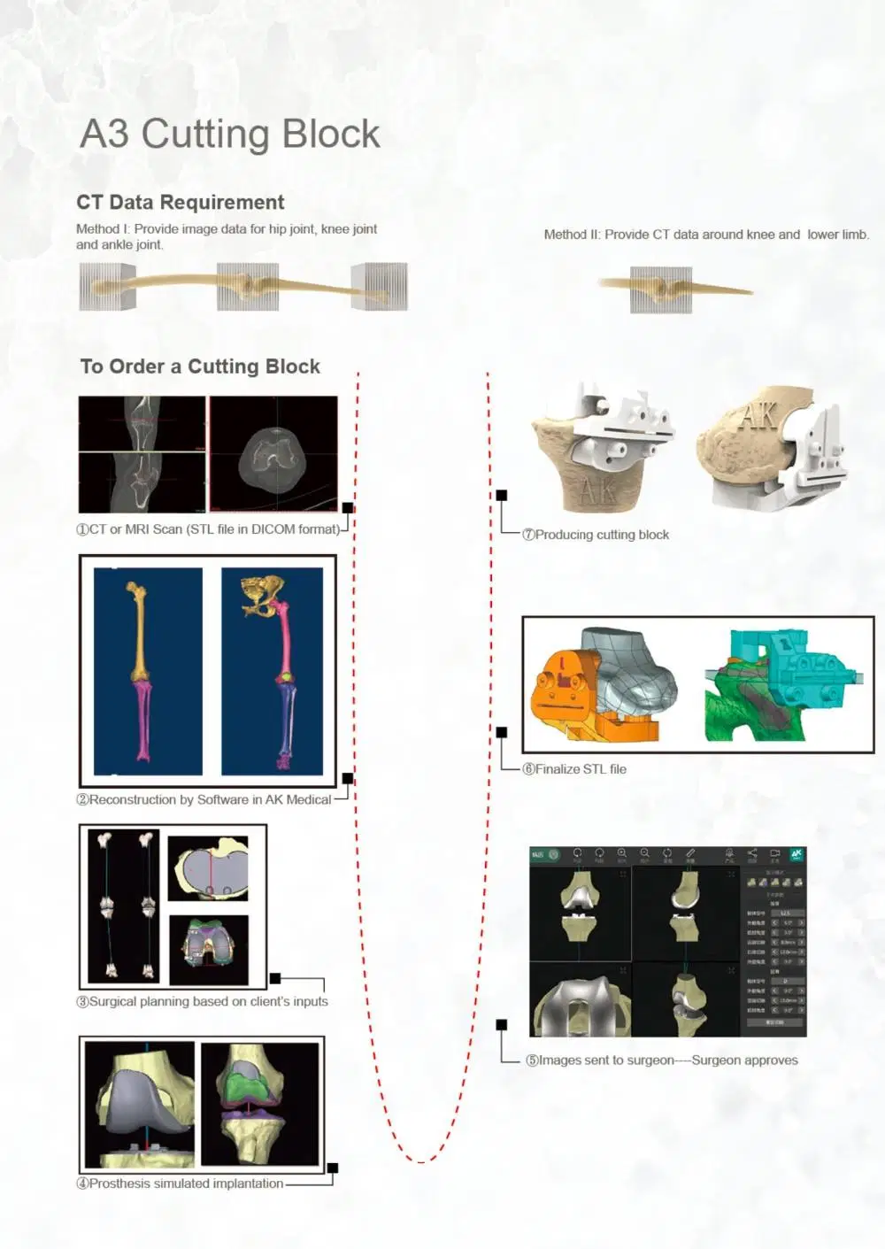 S-ROM Titanium Alloy Cementless Hip Joints for Revision Arthroplasty Surgery